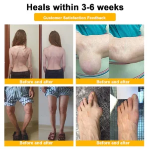 BEE VENOM LITHOSPERMUM Pain-Relief Bone Healing Cream