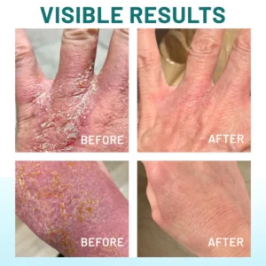 Lovilds® Probiotic + B 24-7 Moisture Eczema Relief Cream