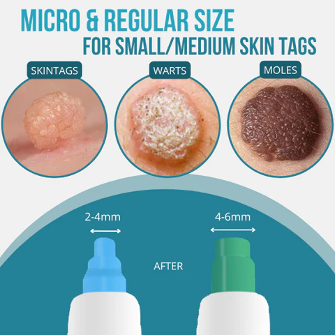 14Pcs Left🔥 | Bikenda® Auto-Micro Skin Tag Remover Kit