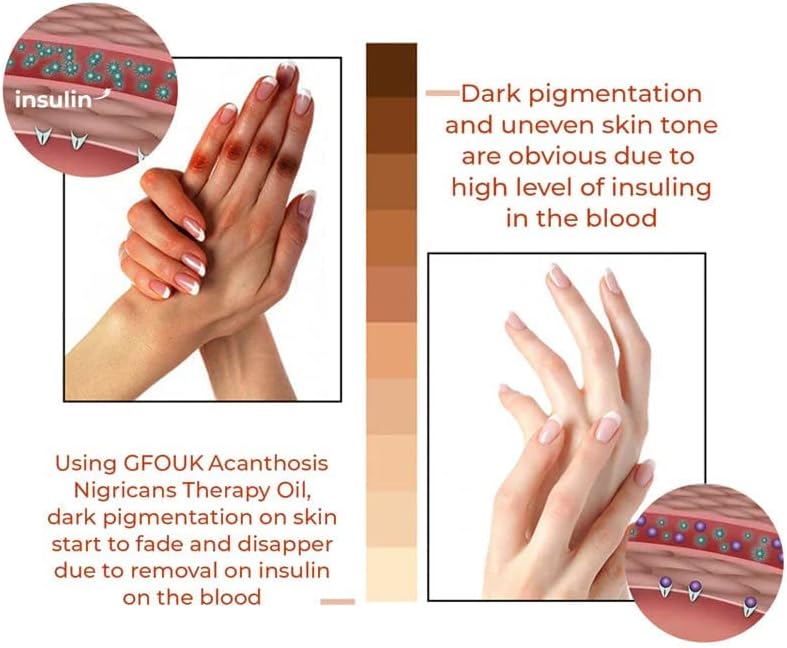 Oveallgo™ Therapy Oil for Acanthosis Nigricans