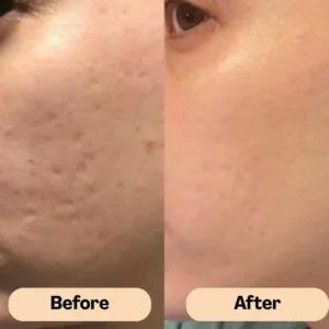 ReviaSkin™ Silicone Scar Stick