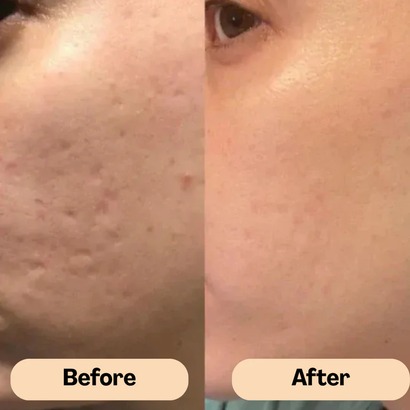 ReviaSkin™ Silicone Scar Stick