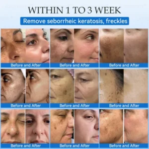 𝐉𝐚𝐬𝐬𝐞𝐞𝐦® 𝐍𝐨𝐧-𝐈𝐧𝐯𝐚𝐬𝐢𝐯𝐞 𝐌𝐨𝐥𝐞 & 𝐖𝐚𝐫𝐭 𝐋𝐚𝐬𝐞𝐫 𝐑𝐞𝐦𝐨𝐯𝐚𝐥 𝐏𝐞𝐧