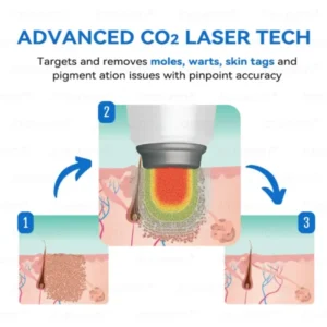 𝐉𝐚𝐬𝐬𝐞𝐞𝐦® 𝐍𝐨𝐧-𝐈𝐧𝐯𝐚𝐬𝐢𝐯𝐞 𝐌𝐨𝐥𝐞 & 𝐖𝐚𝐫𝐭 𝐋𝐚𝐬𝐞𝐫 𝐑𝐞𝐦𝐨𝐯𝐚𝐥 𝐏𝐞𝐧