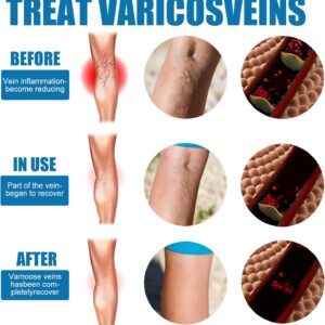 Goodbye Veins - Varicose Veins Spray
