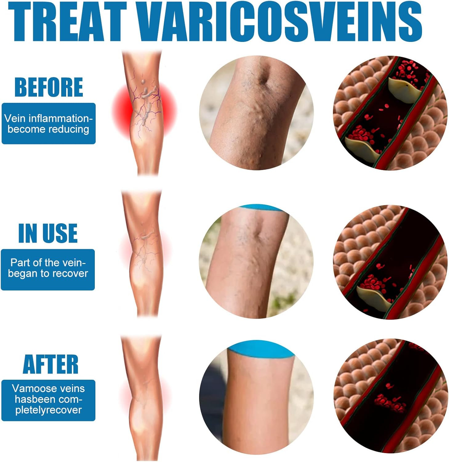 Goodbye Veins - Varicose Veins Spray