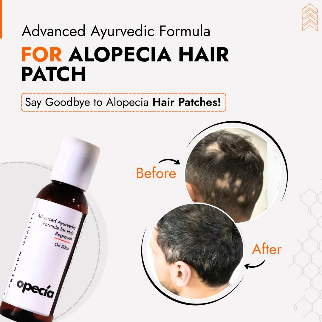 Advanced Formula For Alopecia Treatment
