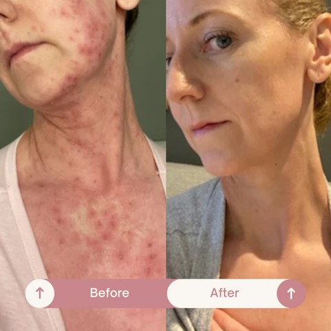 Natural Herbal Formula for Fast, Steroid-Free Relief