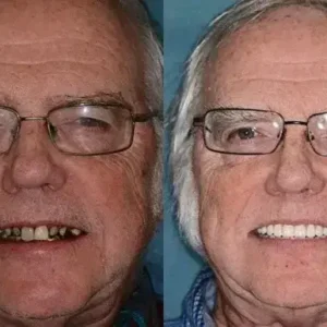 SMILE HZA™ Premium Denture