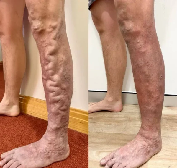 Herbal Varicose Vein Relief & Leg Comfort Cream