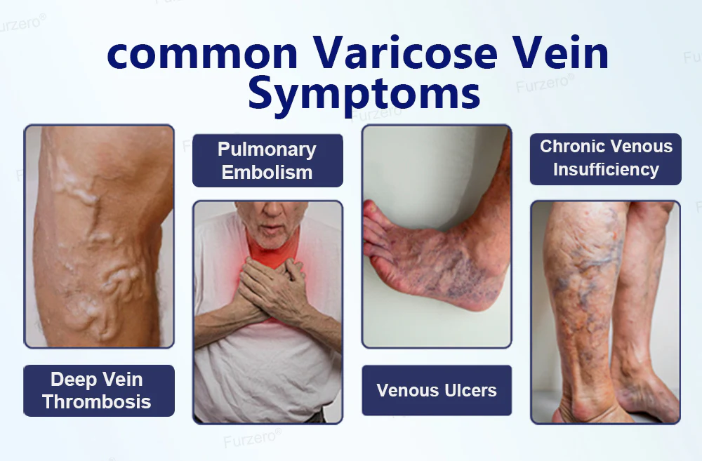 Herbal Varicose Vein Relief & Leg Comfort Cream