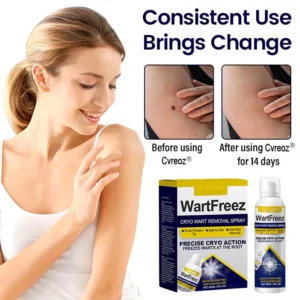 WartFreez Cryo Wart Removal Spray
