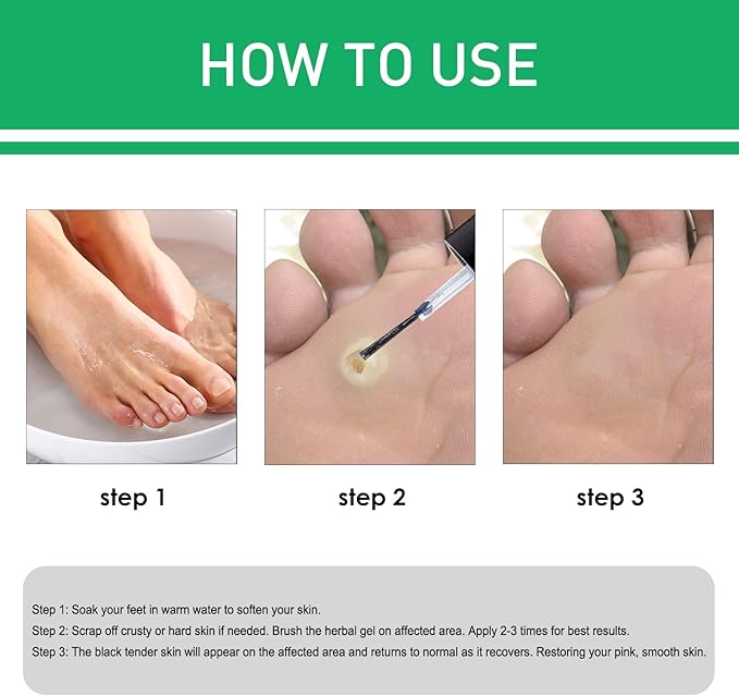 JAYSUING Effective Skin Corns Wart Remover Liquid Serum 1c1e21" face="Roboto, Arial, sans-serif">????কর্ন এবং কলাস হল ত্বকের পুরু, শক্ত স্তর যা ত্বক যখন ঘর্ষণ বা চাপ থেকে নিজেকে রক্ষা করার চেষ্টা করে তখন তৈরি হয়। এগুলি প্রায়শই পা এবং পায়ের আঙ্গুলে বা হাত এবং আঙ্গুলে তৈরি হয়। কর্ন ব্যথাজনক হতে পারে, বিশেষ করে যখন চাপ প্রয়োগ করা হয় এবং আকার এবং চেহারায় ভিন্নতা থাকতে পারে।????