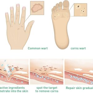 JAYSUING Effective Skin Corns Wart Remover Liquid Serum 1c1e21