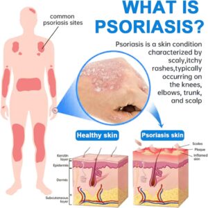 PsoriCalm Magnesium Soothing Spray