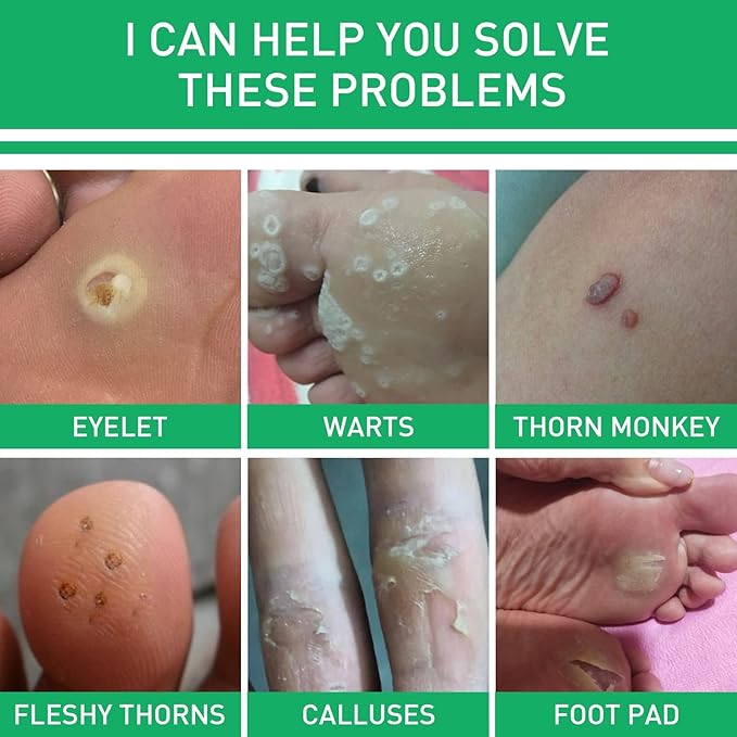 JAYSUING Effective Skin Corns Wart Remover Liquid Serum 1c1e21" face="Roboto, Arial, sans-serif">????কর্ন এবং কলাস হল ত্বকের পুরু, শক্ত স্তর যা ত্বক যখন ঘর্ষণ বা চাপ থেকে নিজেকে রক্ষা করার চেষ্টা করে তখন তৈরি হয়। এগুলি প্রায়শই পা এবং পায়ের আঙ্গুলে বা হাত এবং আঙ্গুলে তৈরি হয়। কর্ন ব্যথাজনক হতে পারে, বিশেষ করে যখন চাপ প্রয়োগ করা হয় এবং আকার এবং চেহারায় ভিন্নতা থাকতে পারে।????