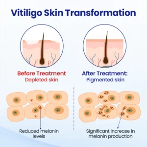 vitiligo support spray for targeted skin areas