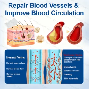 Microneedle Varicose Vein Relief Patch – Deep Penetration Formula