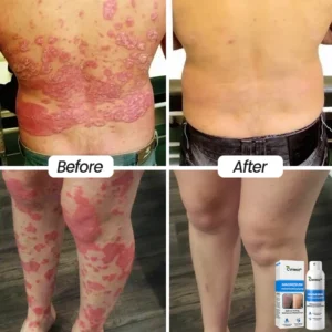 Cvreoz® Magnesium Herbal Psoriasis Spray