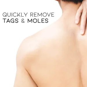 skin tag removal solution