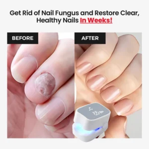 Laser Nail Fungus Treatment Device – Deep Penetration & Fast Repair
