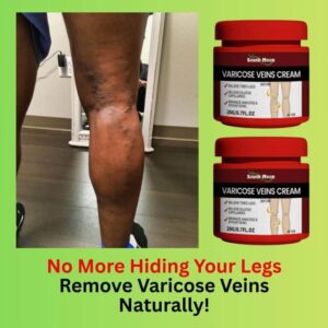 Herbal Varicose Vein Relief Cream – Circulation & Leg Comfort Formula