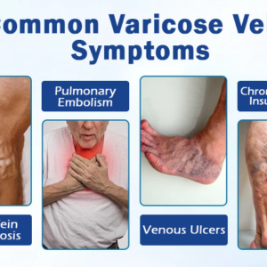 Herbal Varicose Vein Support Capsules – Circulation & Leg Relief