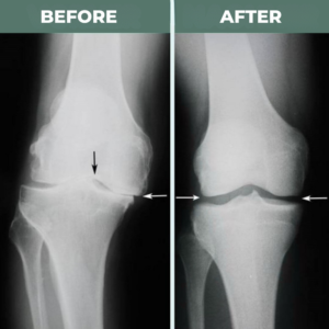 flexiknee knee brace