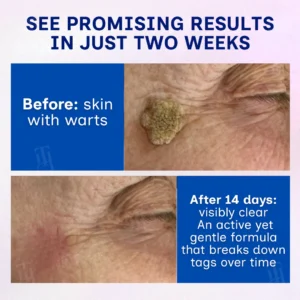 mess-free wart removal treatment by rzxea brand