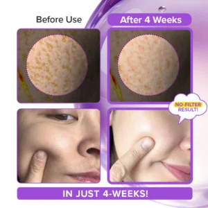 advanced bio-needling renewal cream