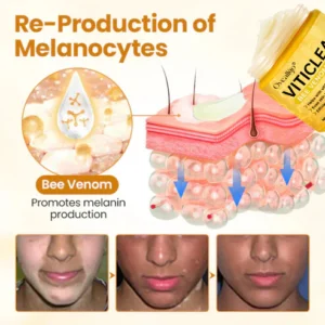 soothing white patches with viticlear bee venom cream