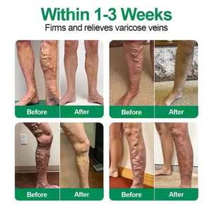 reducing spider veins with healrize veintarget patch