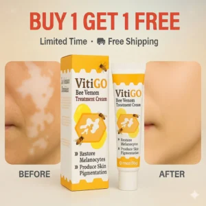 natural vitiligo treatment support cream vitigo