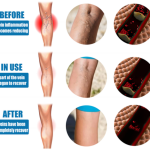 odalit vein therapy cream