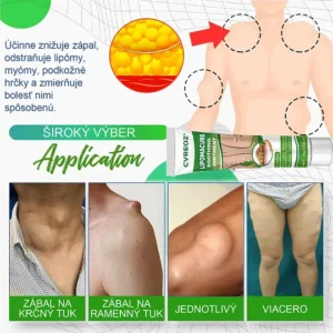 cvreoz lipoma treatment results before and after