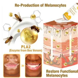 md vitigo advanced restore cream for skin tone