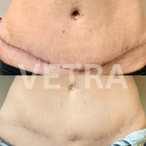 vetra therapy for enhancing scar tissue texture