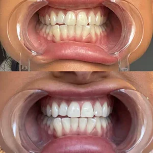 advanced oral whitening technology by bboji brand
