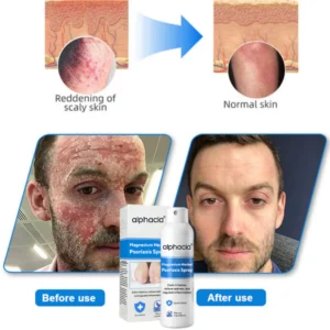 alphacia psoriasis spray before and after scaling reduction